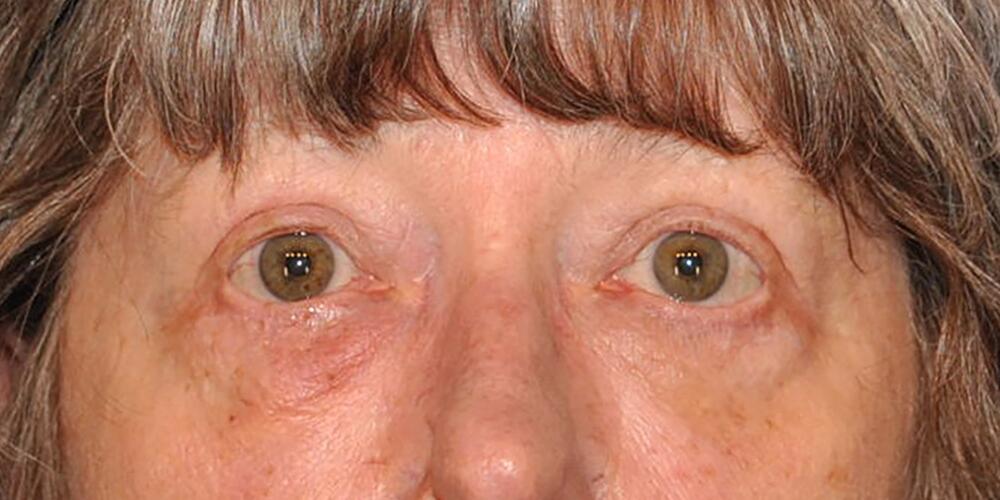 Blepharoplasty Patient 01 — After (2 of 6)