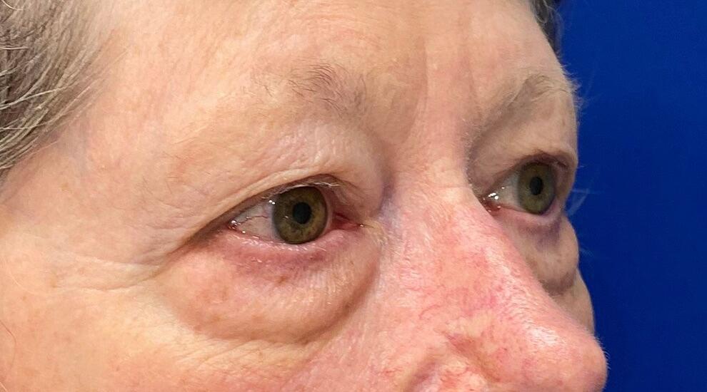 Blepharoplasty Patient 01 — Before (3 of 6)