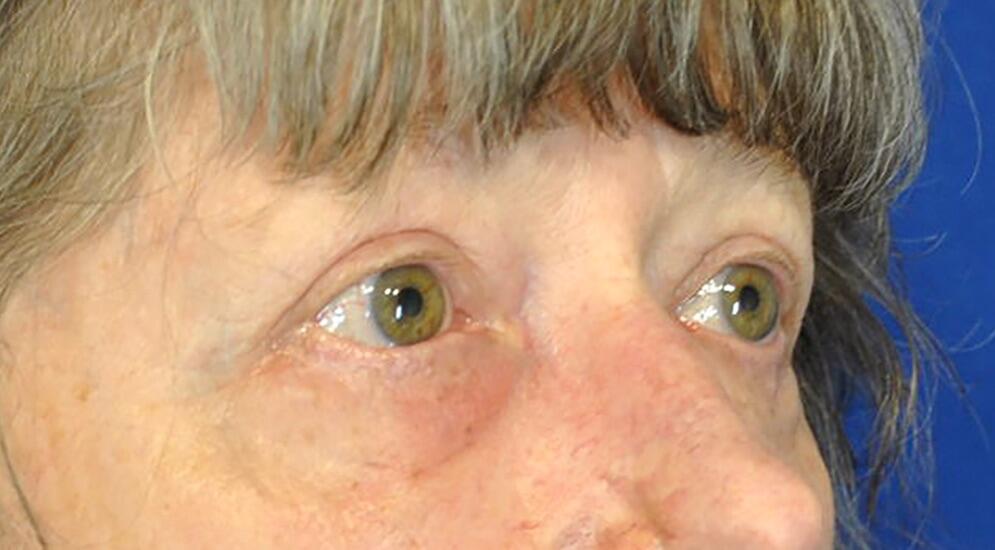 Blepharoplasty Patient 01 — After (4 of 6)
