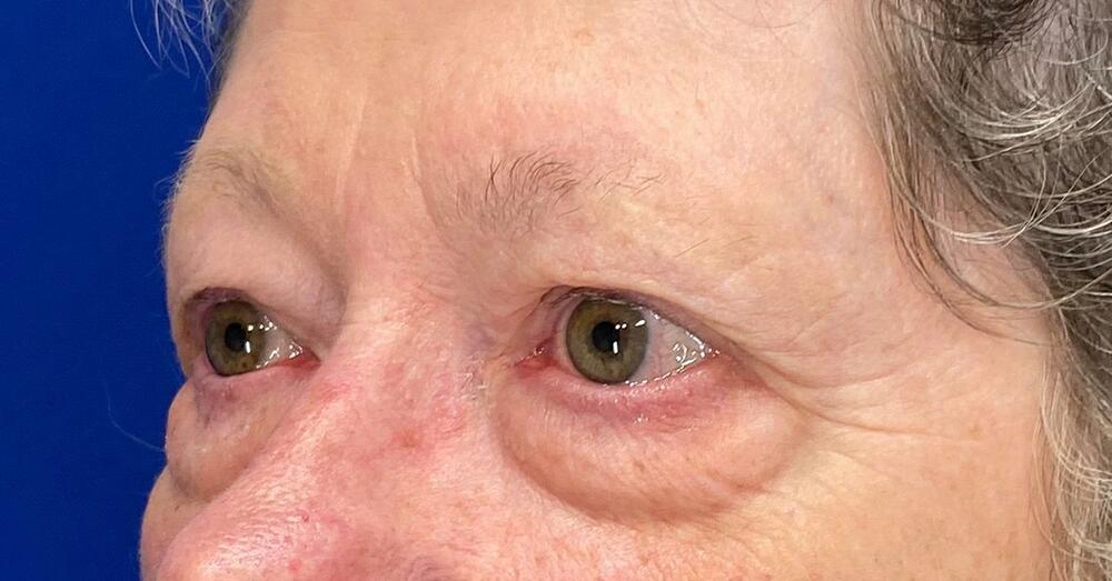Blepharoplasty Patient 01 — Before (5 of 6)
