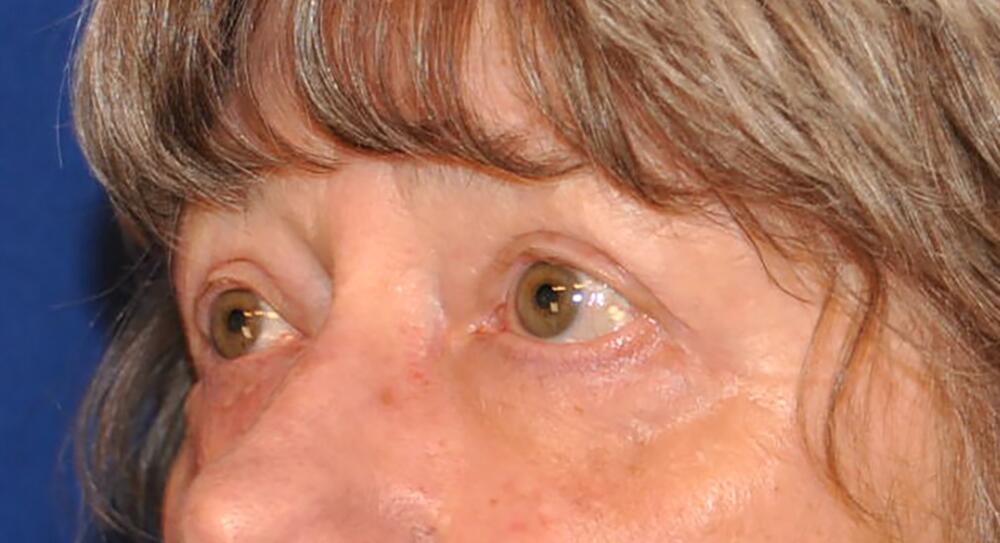 Blepharoplasty Patient 01 — After (6 of 6)