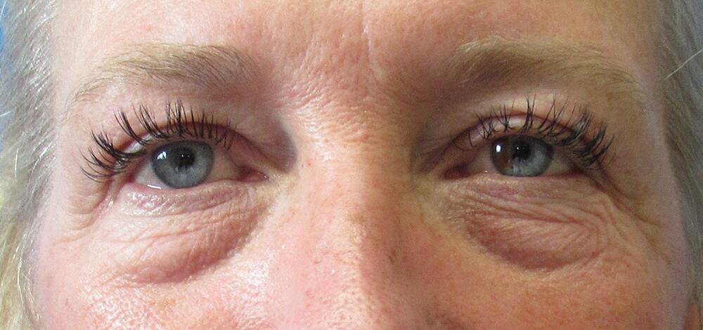 Blepharoplasty Patient 02 — Before (1 of 6)