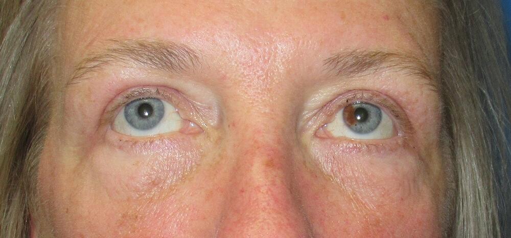 Blepharoplasty Patient 02 — After (2 of 6)