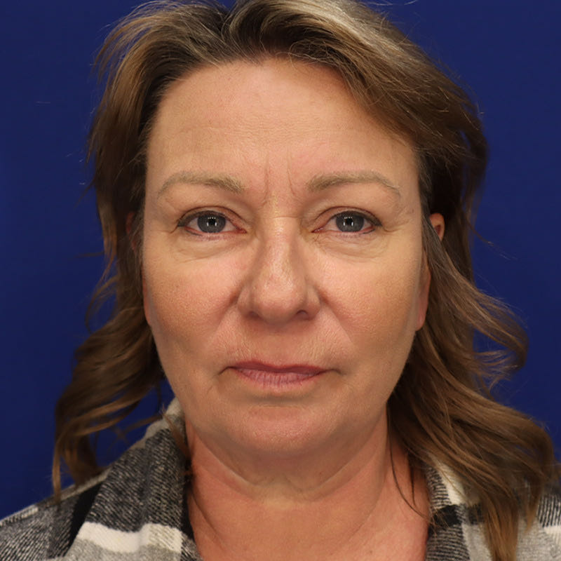 Facelift & Neck Lift Patient 01 — Before (1 of 6)