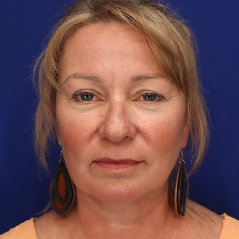 Facelift & Neck Lift Patient 01 — After (2 of 6)