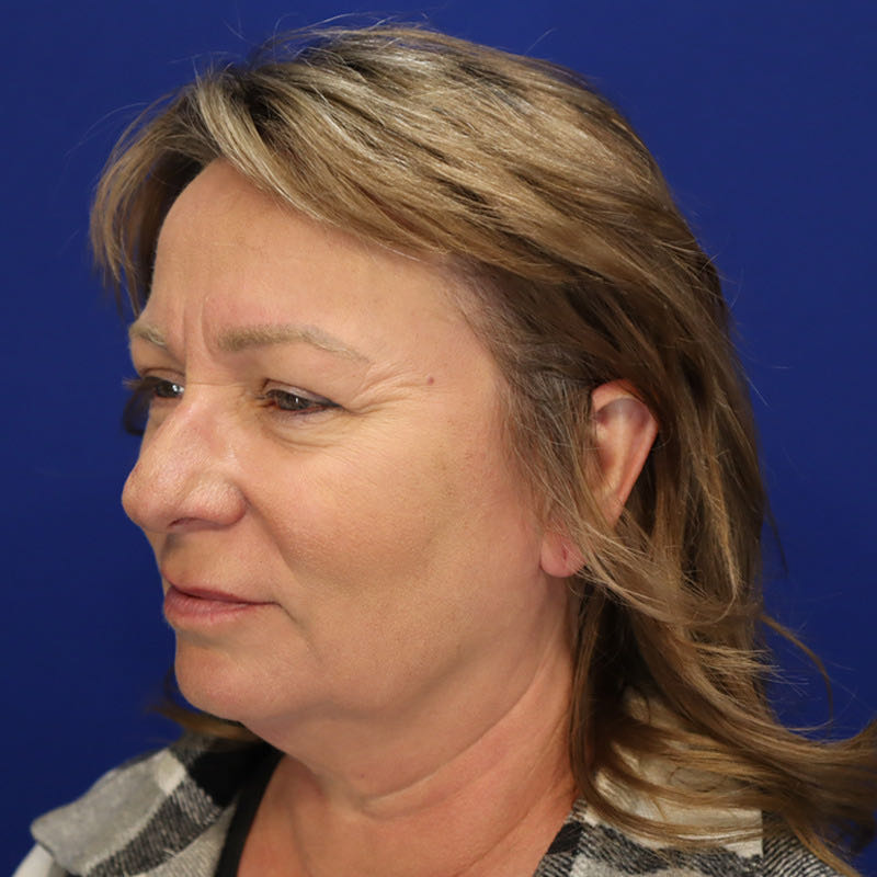 Facelift & Neck Lift Patient 01 — Before (3 of 6)