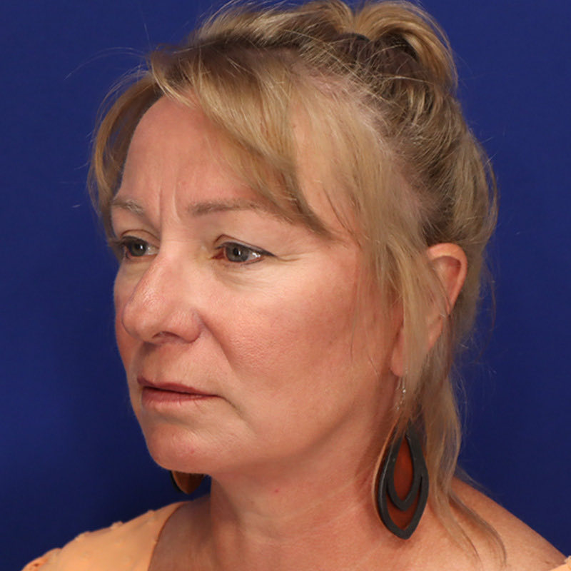 Facelift & Neck Lift Patient 01 — After (4 of 6)