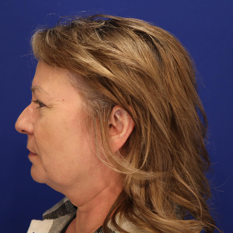 Facelift & Neck Lift Patient 01 — Before (5 of 6)