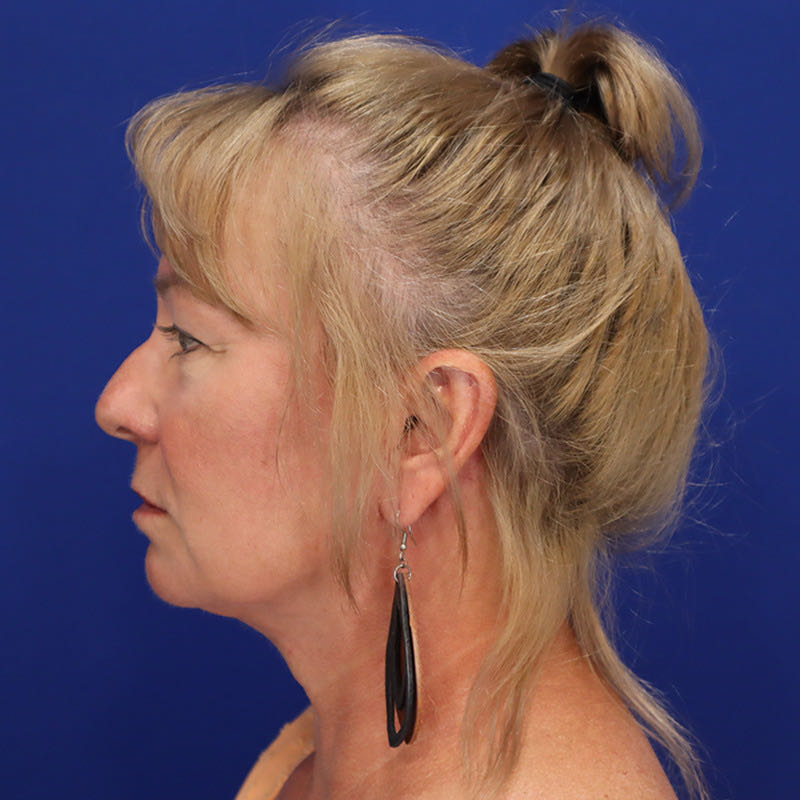 Facelift & Neck Lift Patient 01 — After (6 of 6)