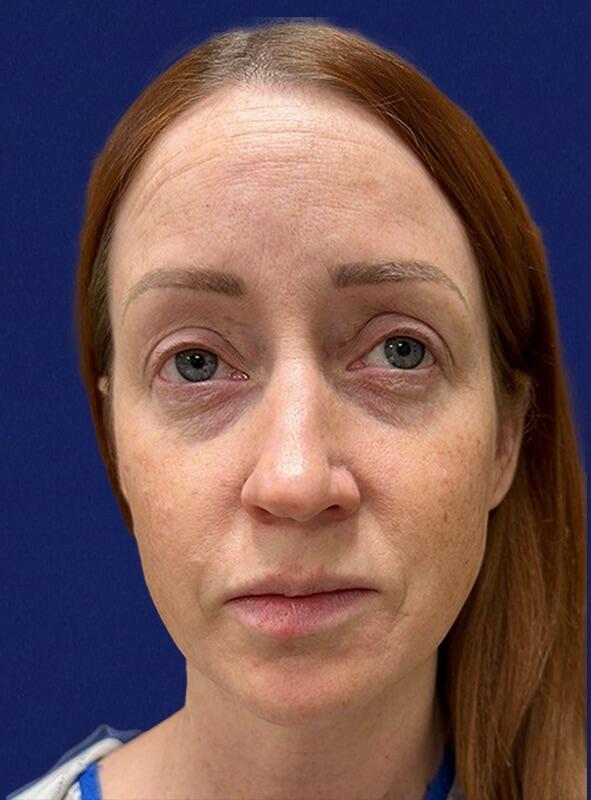 Neck Liposuction Patient 01 — Before (1 of 6)