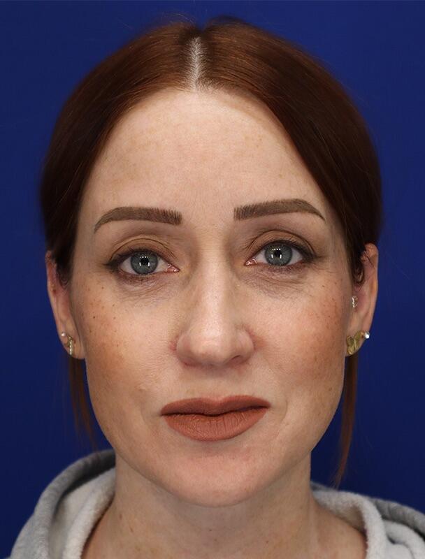 Neck Liposuction Patient 01 — After (2 of 6)