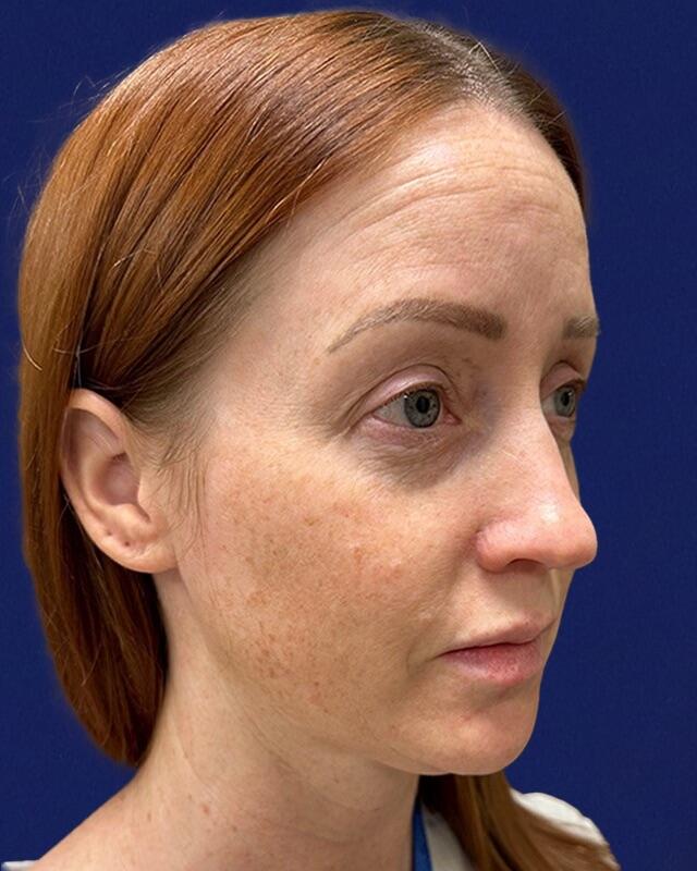 Neck Liposuction Patient 01 — Before (3 of 6)