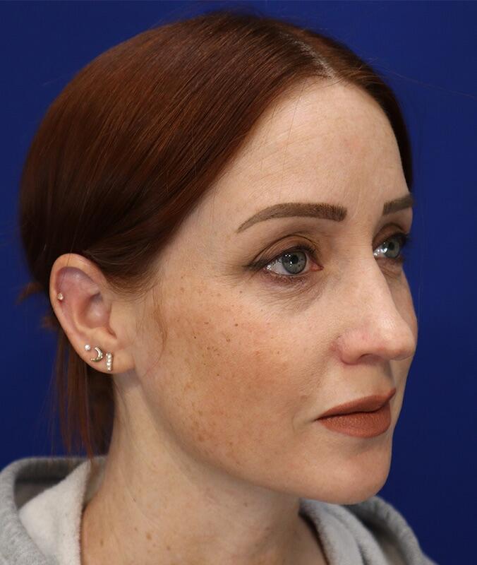 Neck Liposuction Patient 01 — After (4 of 6)