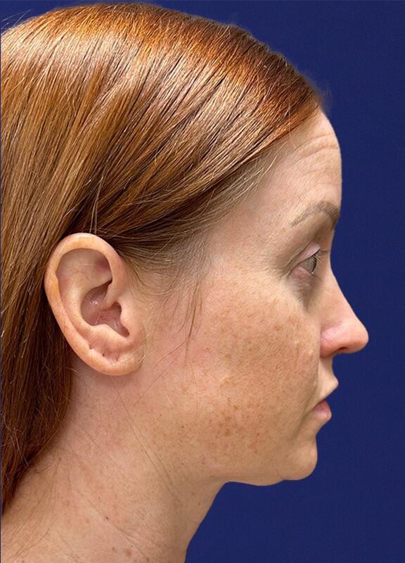 Neck Liposuction Patient 01 — Before (5 of 6)