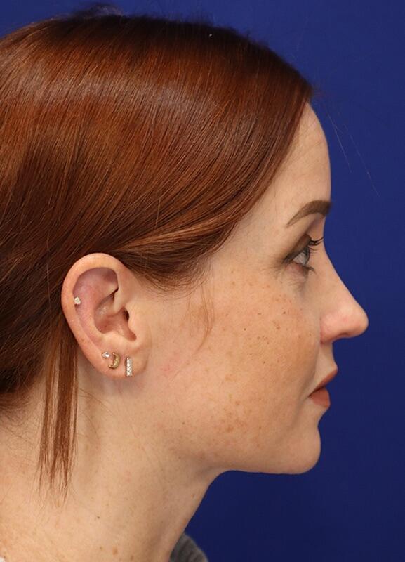 Neck Liposuction Patient 01 — After (6 of 6)
