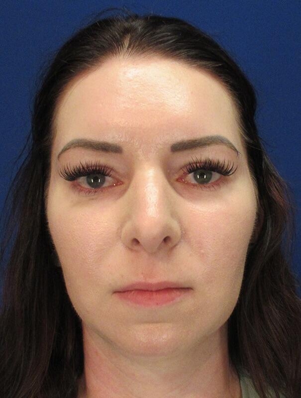 Neck Liposuction Patient 02 — Before (1 of 6)