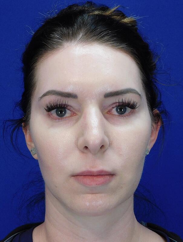 Neck Liposuction Patient 02 — After (2 of 6)