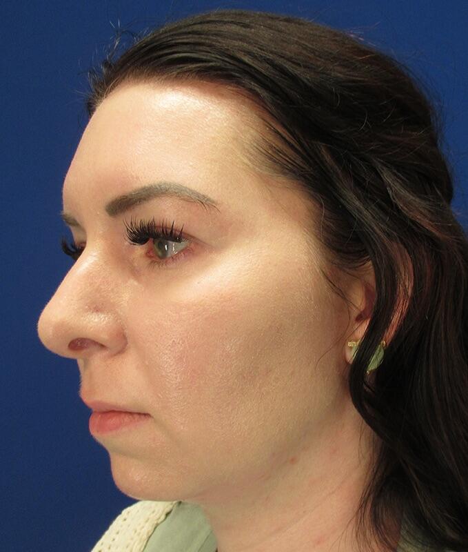 Neck Liposuction Patient 02 — Before (3 of 6)