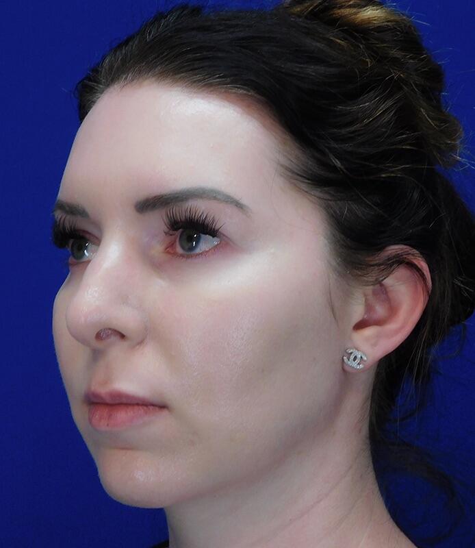 Neck Liposuction Patient 02 — After (4 of 6)