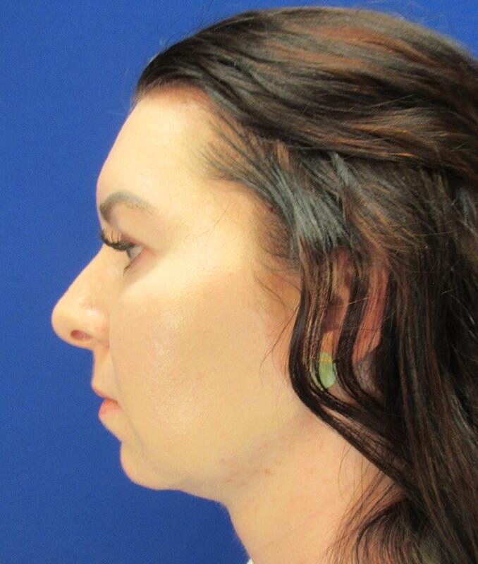 Neck Liposuction Patient 02 — Before (5 of 6)