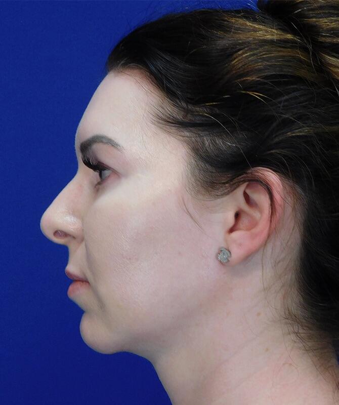 Neck Liposuction Patient 02 — After (6 of 6)