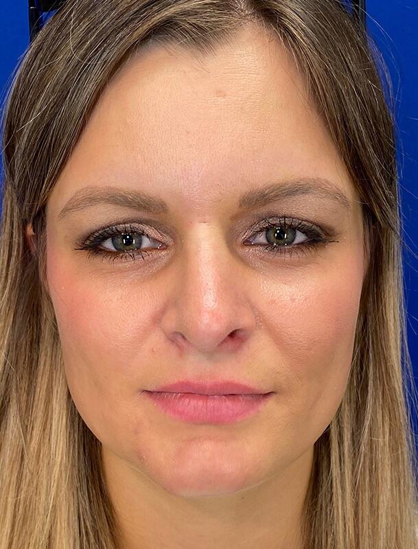 Rhinoplasty Patient 01 — After (2 of 6)