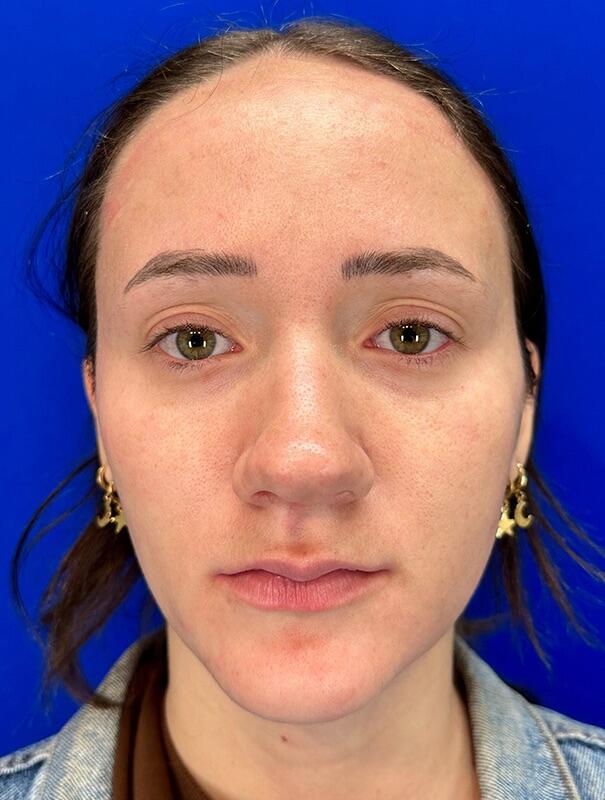 Rhinoplasty Patient 02 — Before (1 of 8)