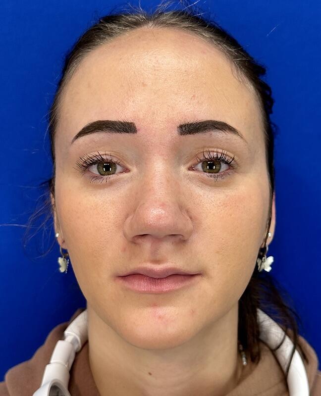 Rhinoplasty Patient 02 — After (2 of 8)