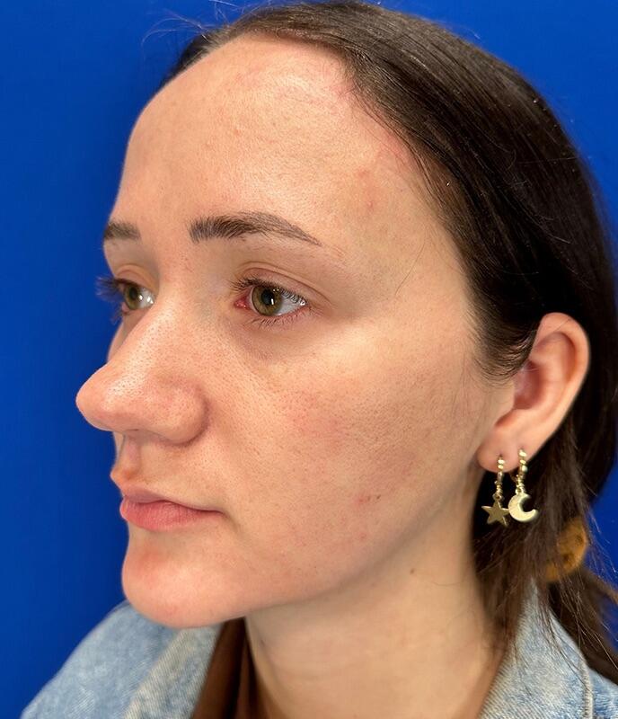 Rhinoplasty Patient 02 — Before (3 of 8)