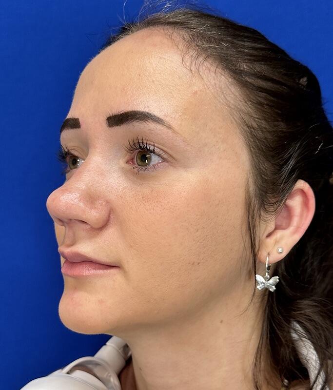 Rhinoplasty Patient 02 — After (4 of 8)