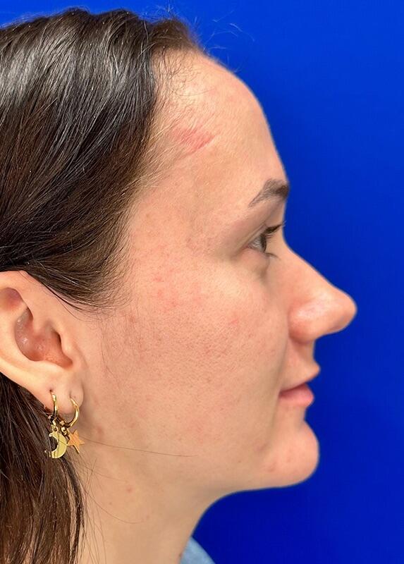 Rhinoplasty Patient 02 — Before (5 of 8)