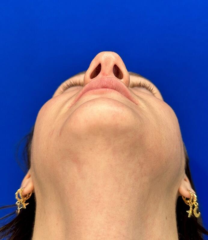 Rhinoplasty Patient 02 — Before (7 of 8)