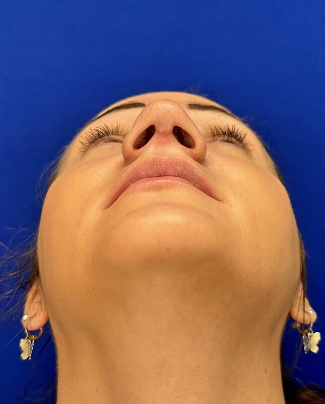 Rhinoplasty Patient 02 — After (8 of 8)