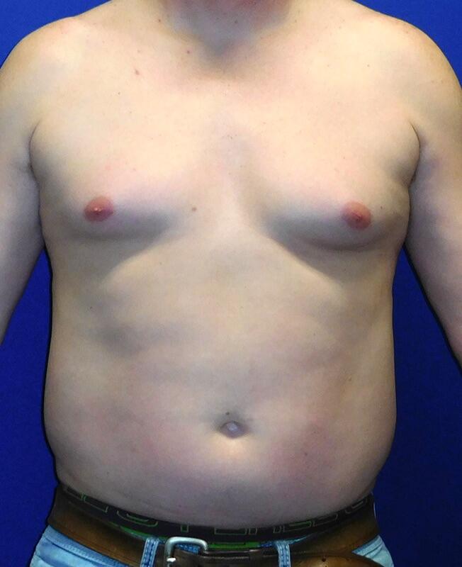 Gynecomastia Surgery Patient 03 — Before (1 of 6)