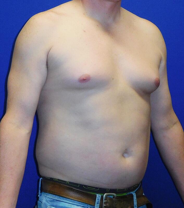 Gynecomastia Surgery Patient 03 — Before (3 of 6)