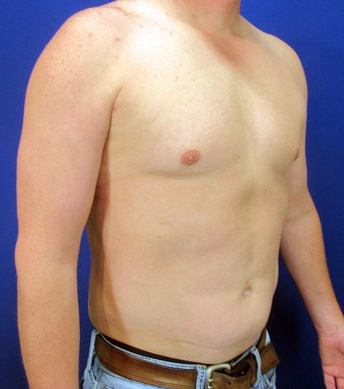 Gynecomastia Surgery Patient 03 — After (4 of 6)