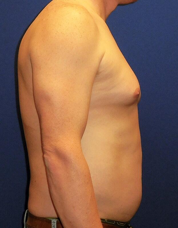 Gynecomastia Surgery Patient 03 — Before (5 of 6)