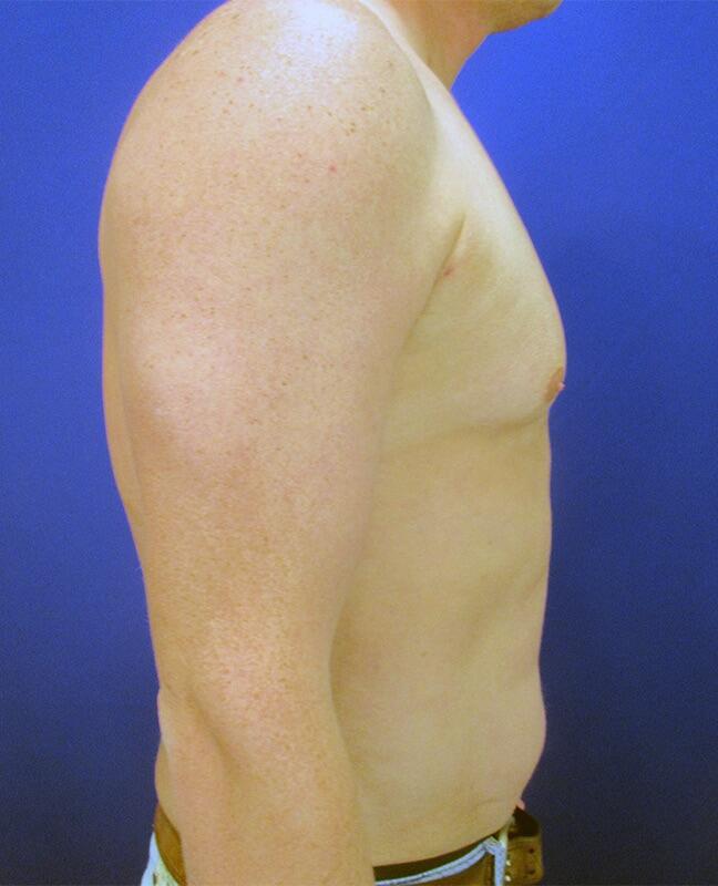 Gynecomastia Surgery Patient 03 — After (6 of 6)