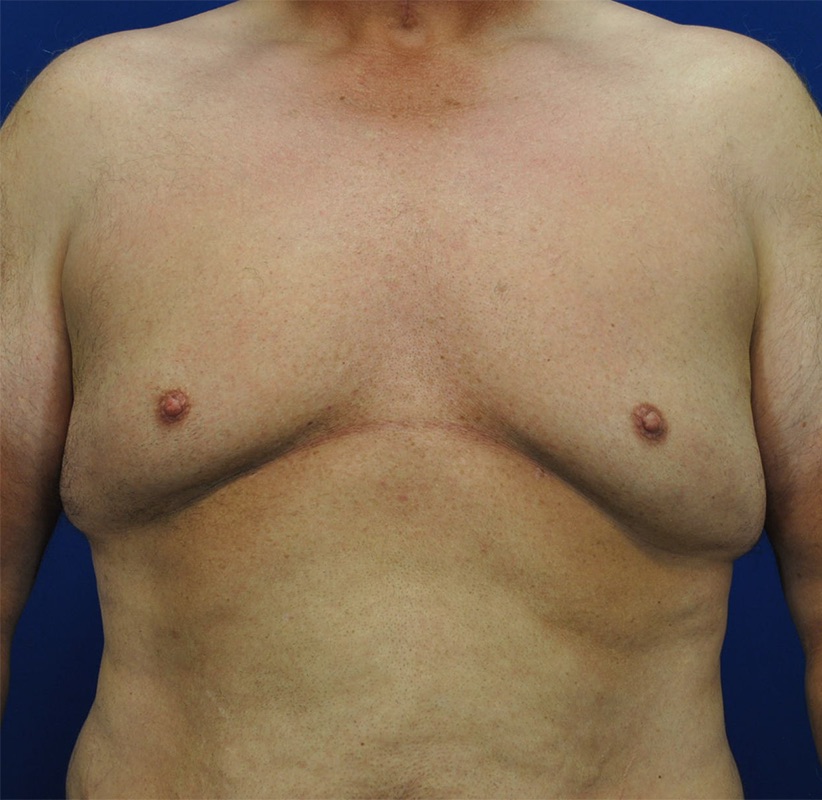 Gynecomastia Surgery Patient 04 — Before (1 of 6)