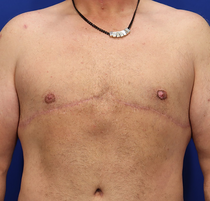 Gynecomastia Surgery Patient 04 — After (2 of 6)