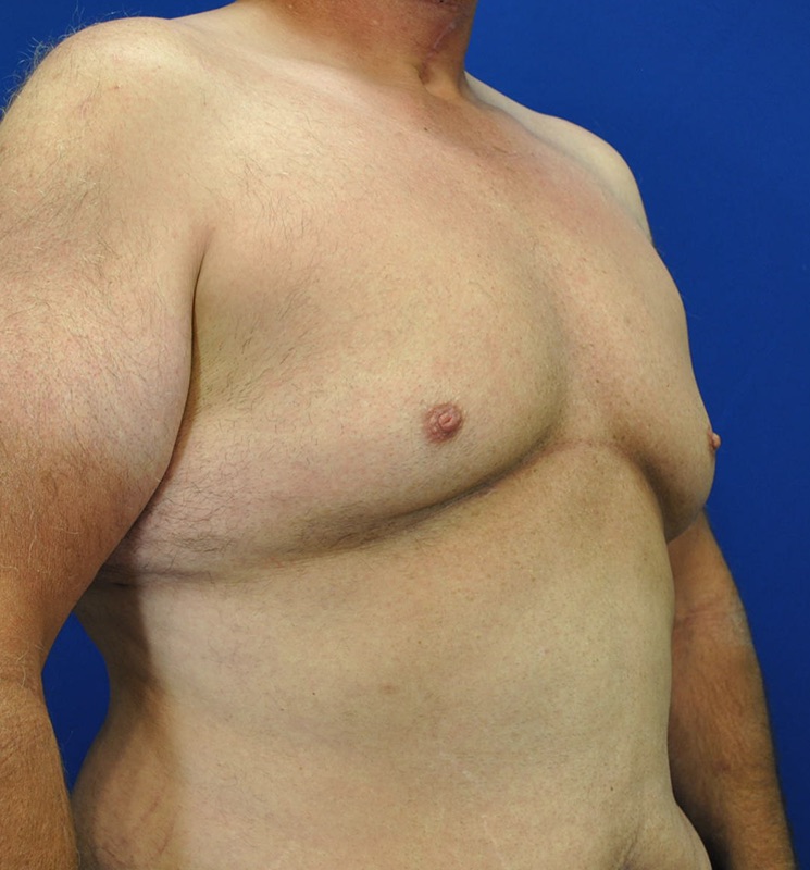 Gynecomastia Surgery Patient 04 — Before (3 of 6)