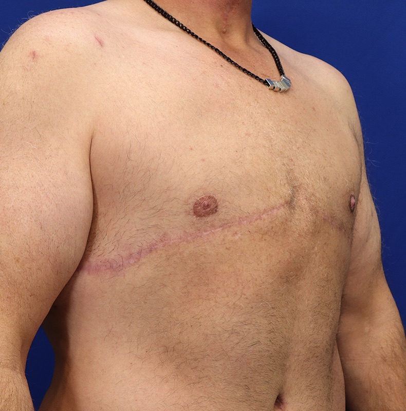 Gynecomastia Surgery Patient 04 — After (4 of 6)