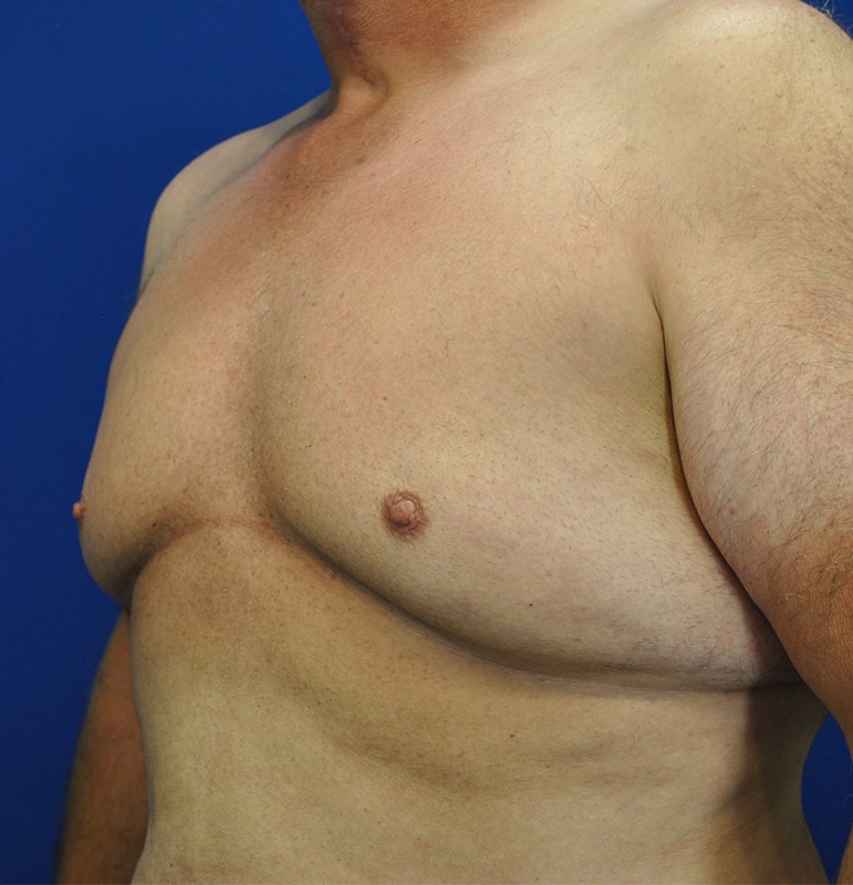 Gynecomastia Surgery Patient 04 — Before (5 of 6)