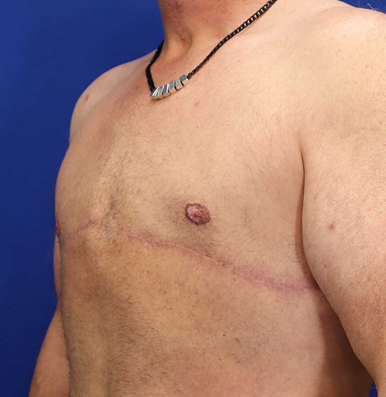 Gynecomastia Surgery Patient 04 — After (6 of 6)