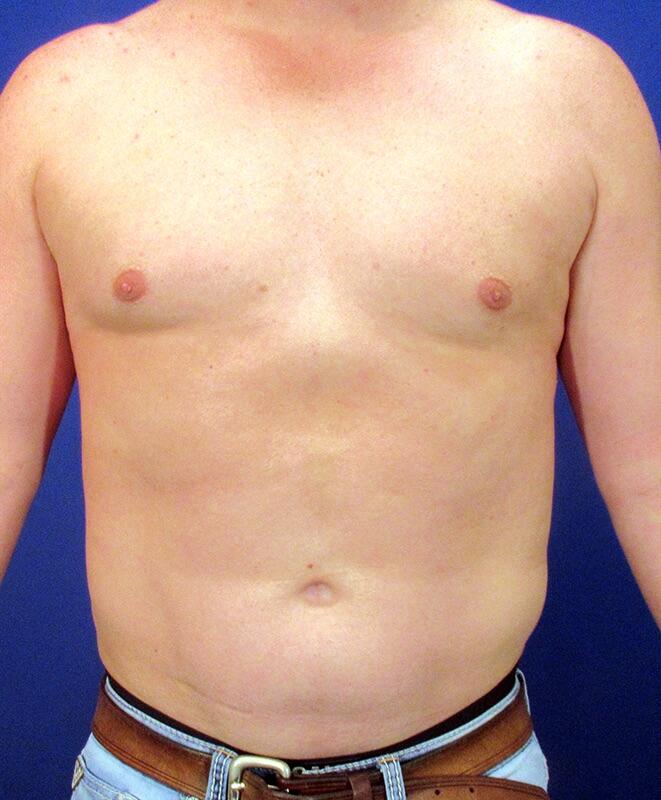 Male Liposuction Patient 01 — After (2 of 6)
